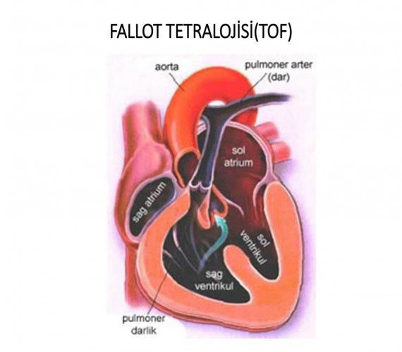 Fallot Tetralojisi