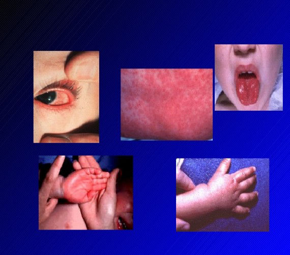 Kawasaki Hastalığı